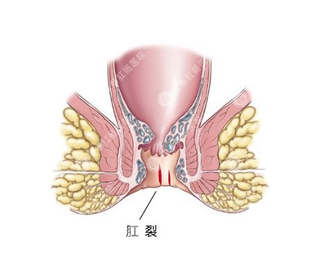 肛裂治疗优选hcpt方法